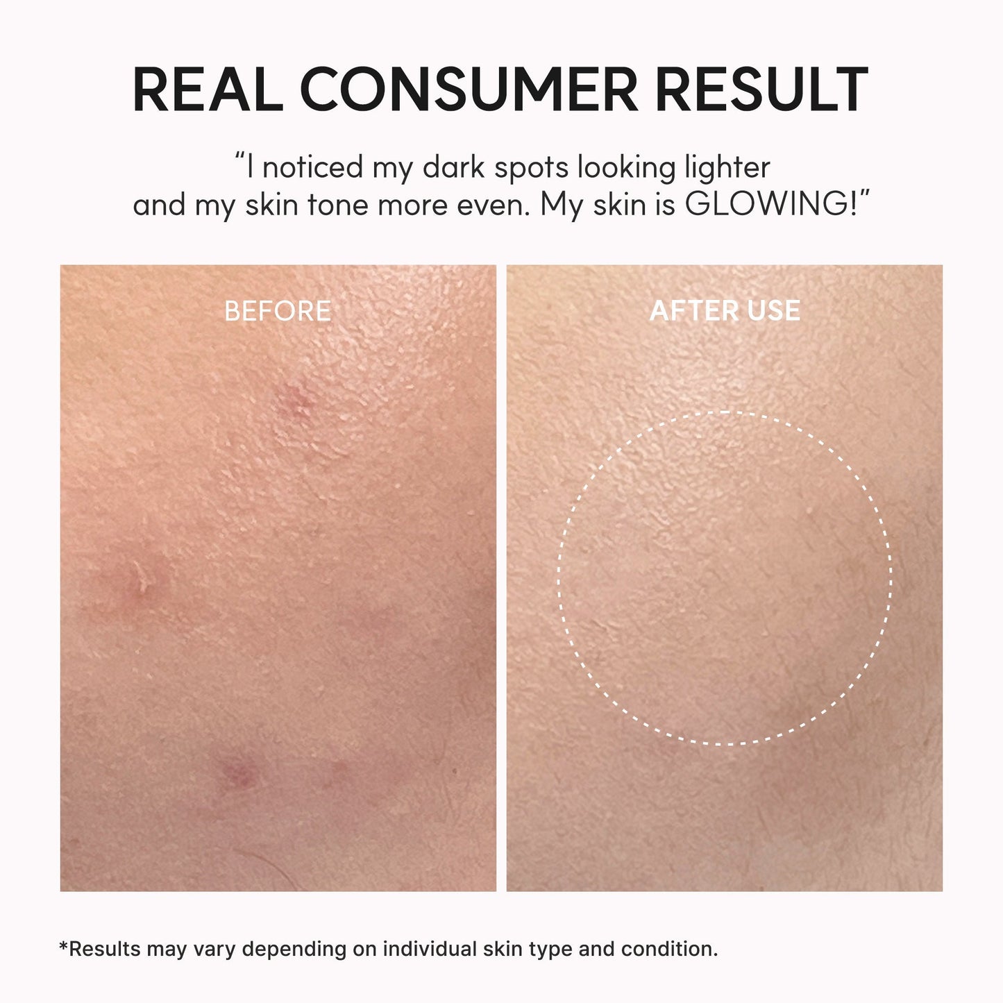 Arencia TXA Booster Shot, Intensive Dark Spot Correcting Serum with 5% TXA, Niacinamide & 10 Peptides for Visible Tone Correction & Radiant-Looking Skin - OVERRATED
