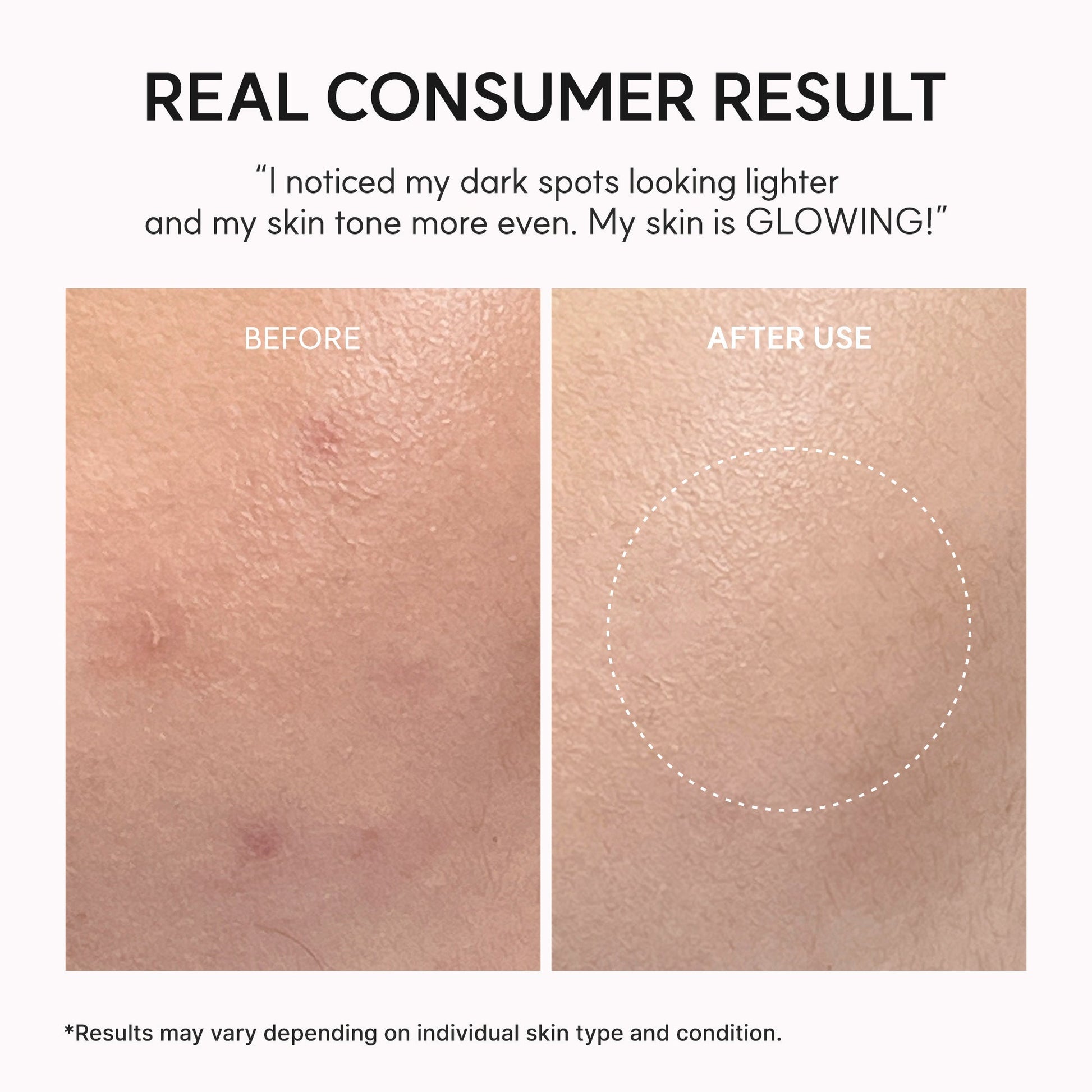 Arencia TXA Booster Shot, Intensive Dark Spot Correcting Serum with 5% TXA, Niacinamide & 10 Peptides for Visible Tone Correction & Radiant-Looking Skin - OVERRATED
