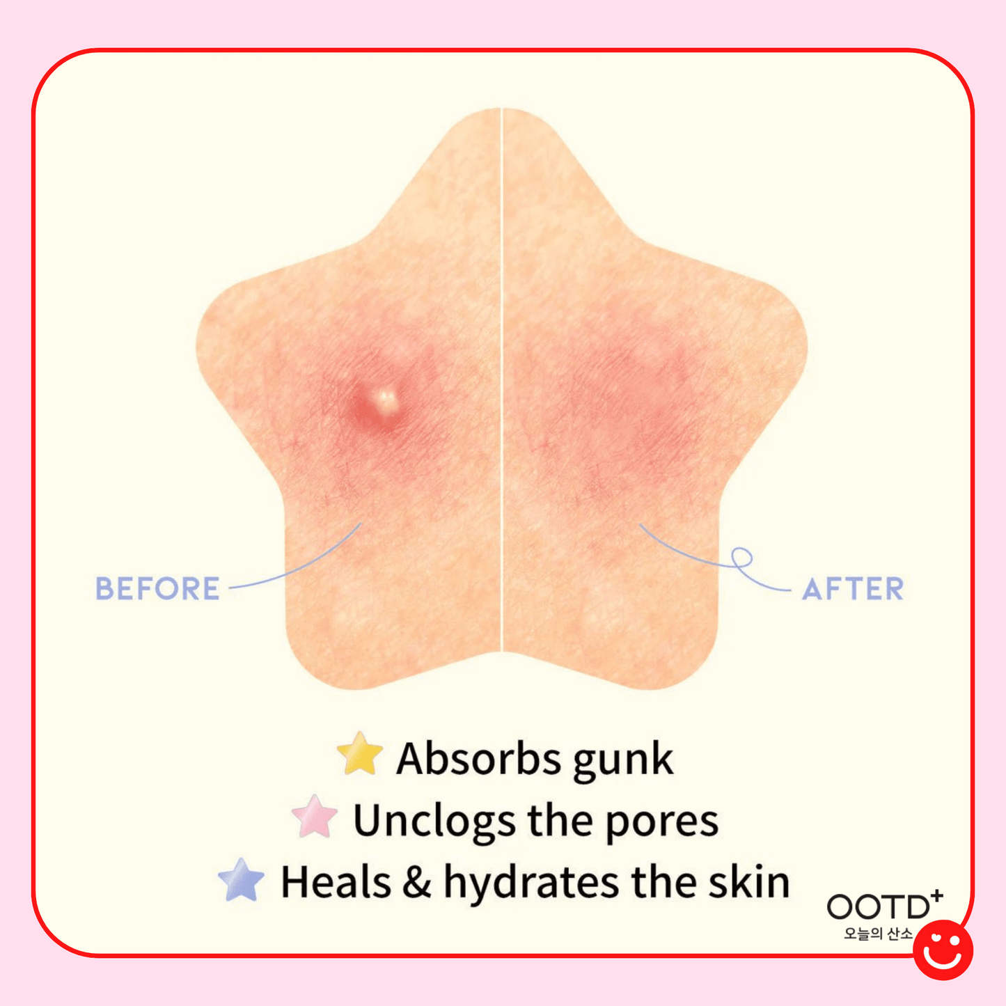 Korean acne spot patch OOTD Beauty Star star shape single patch closeup - Overrated Korean Beauty & More